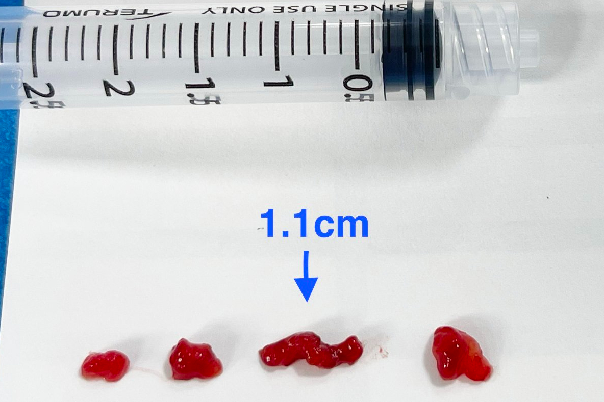 14歲學生突倒地竟是「腦中風」 聯新國際醫院把握黃金時間救命 心臟黏液瘤血栓 0