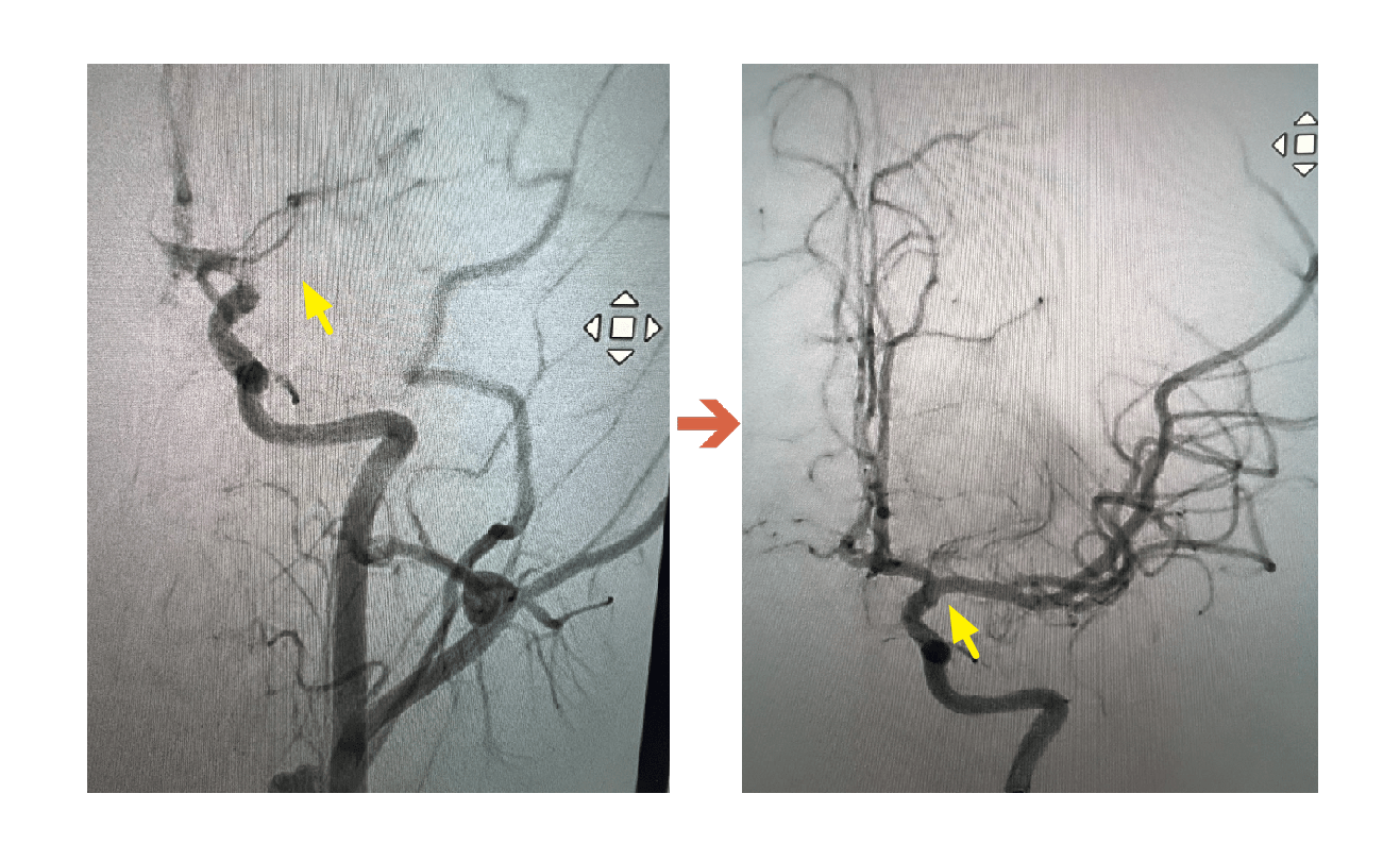 14歲學生突倒地竟是「腦中風」 聯新國際醫院把握黃金時間救命 ICA血管攝影阻塞到打通 0